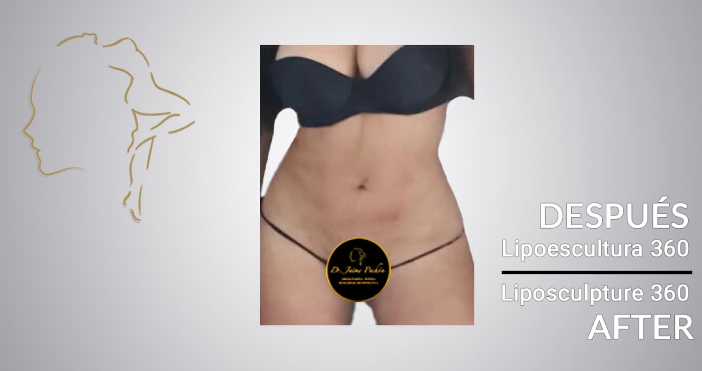Case 10 After Surgery Lipo in Colombia