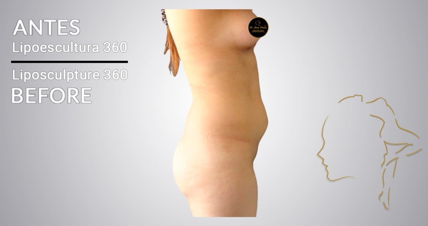Case 12 before lipo 360 in colombia
