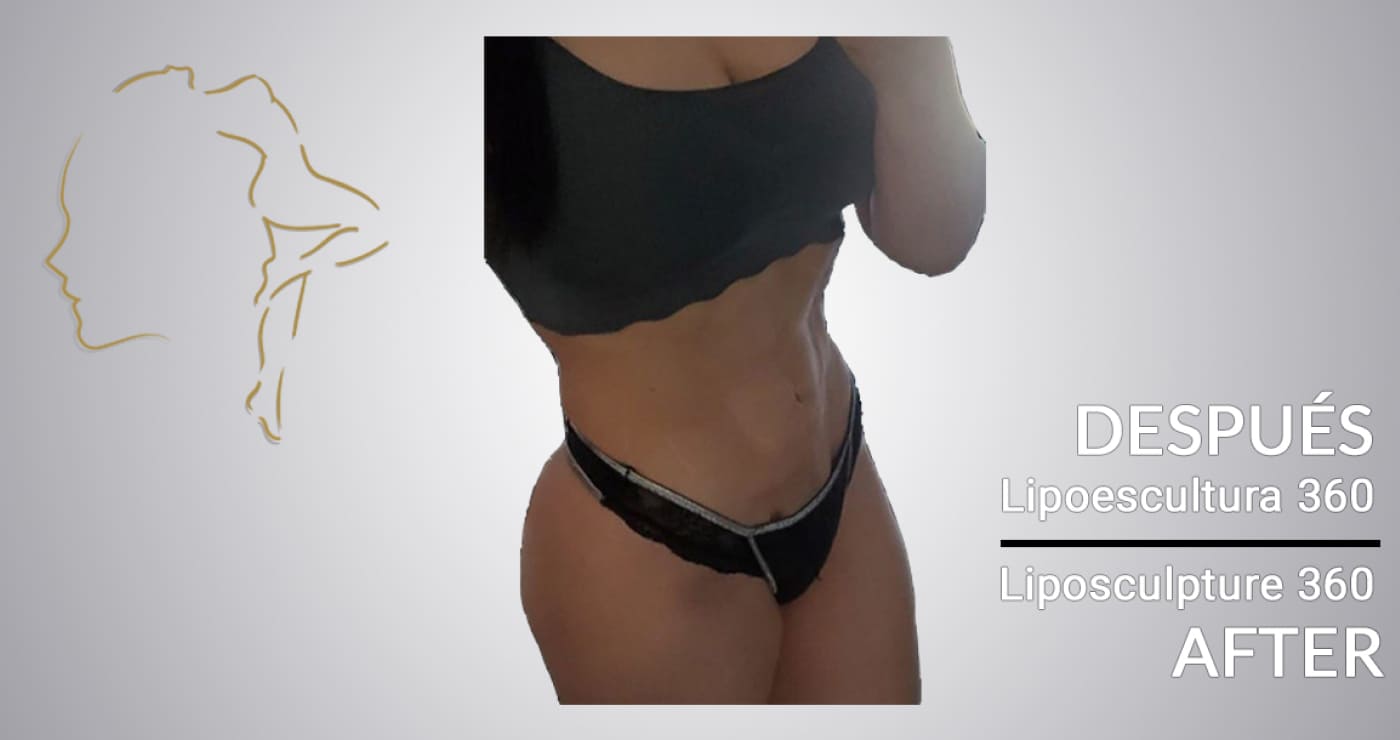 Case 13 After laser liposuction Colombia