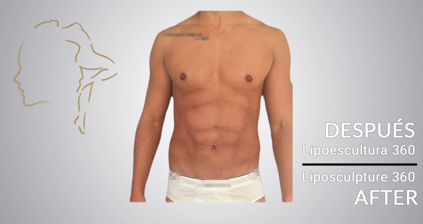 Case 3 After Surgery Laser Lipo Colombia
