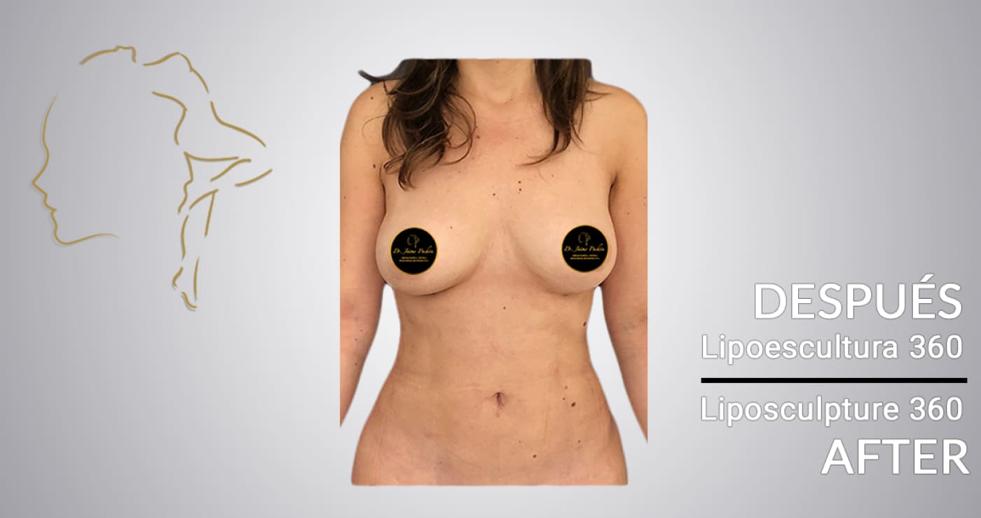 Case 5 after liposuction in Colombia