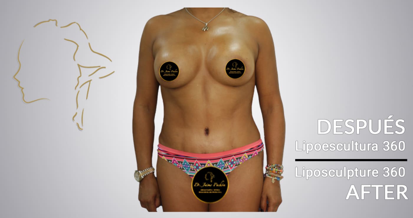 Case 7 after lipo in colombia