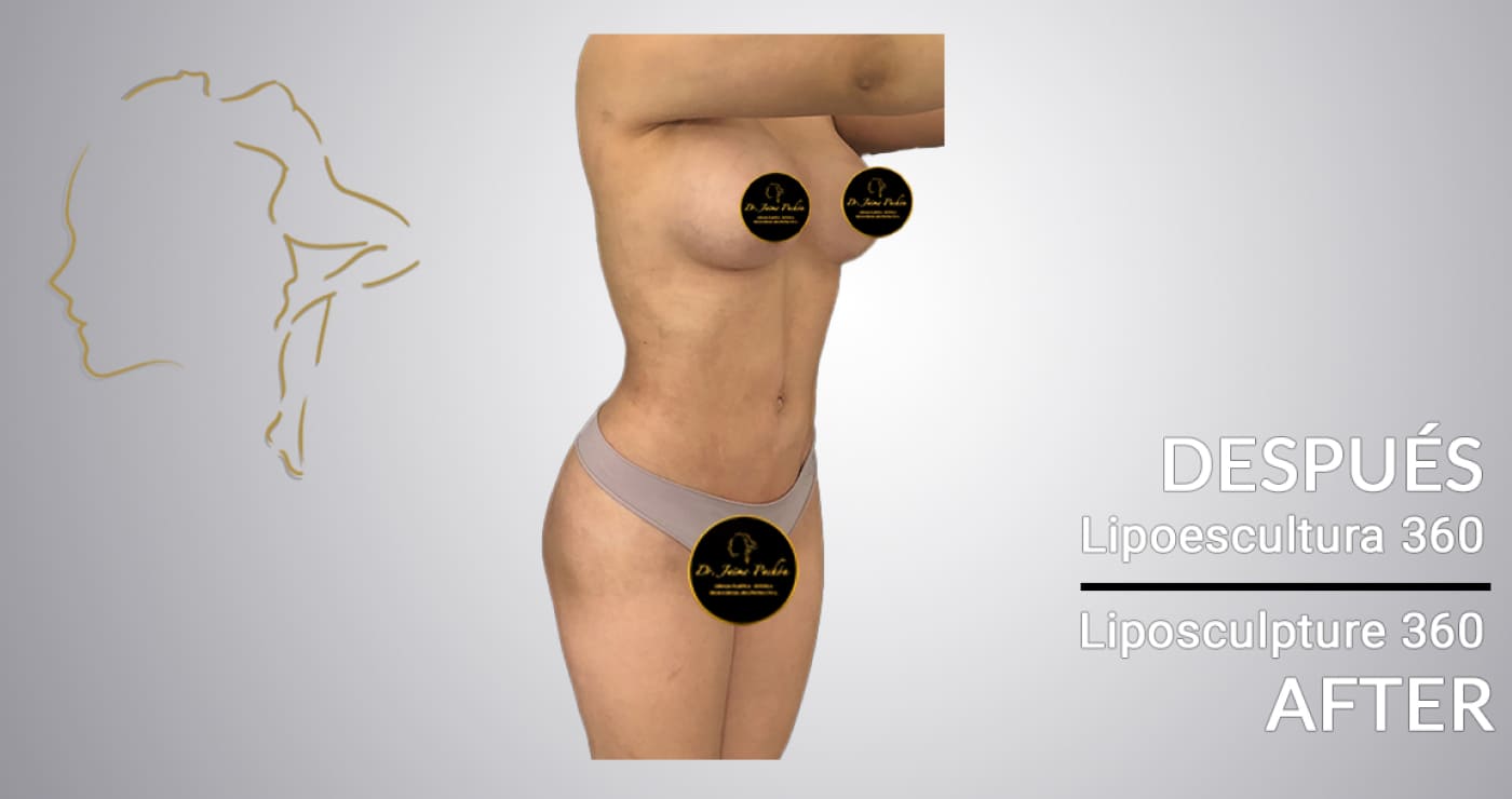 Case 9 After Surgery Liposuction in Colombia